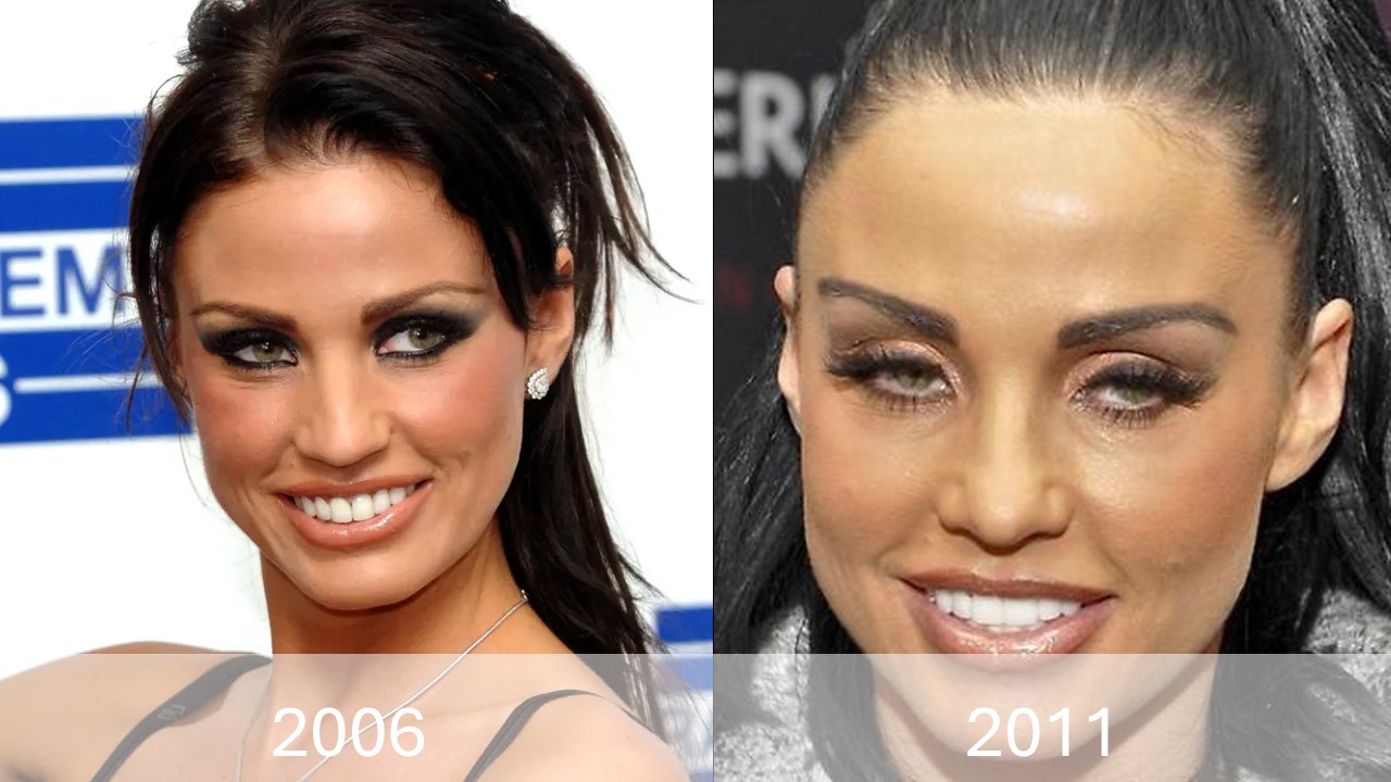 Katie Price Teeth Transformation in 2007