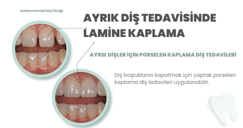 Ayrık diş tedavisinde porselen kaplama diş (lamine kaplama diş) uygulamaları Antalya