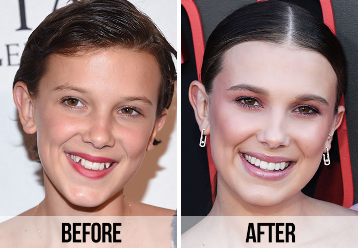 Millie-Bobby-Brown-Before-After