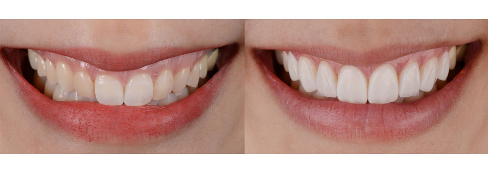 Olivia's Hollywood Smile Turkey Before and After