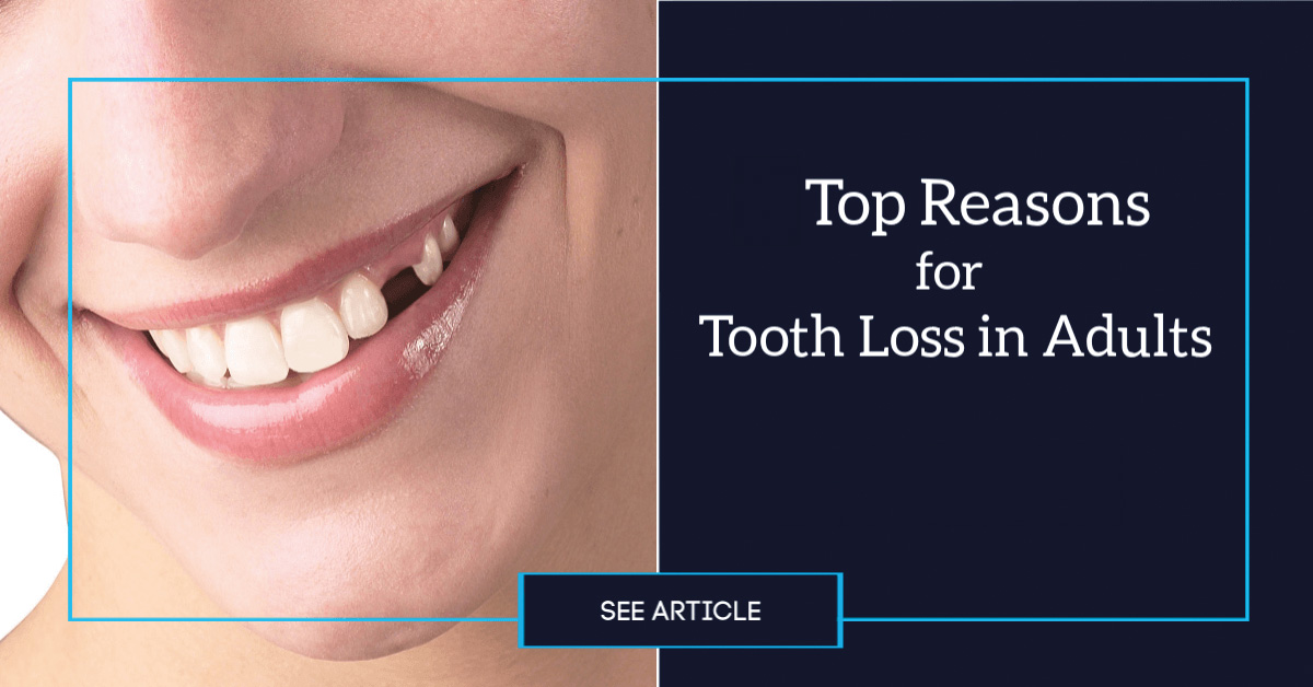 Top reasons for tooth loss in adults