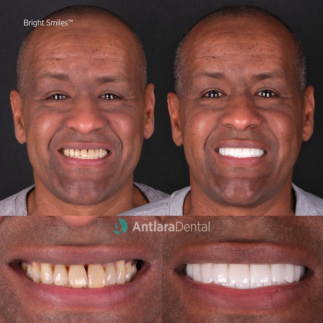 before after tooth color shade