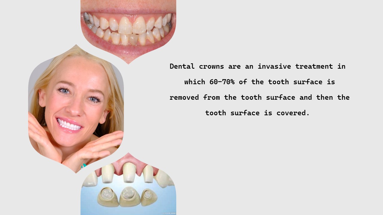 Dental crowns are an invasive treatment.