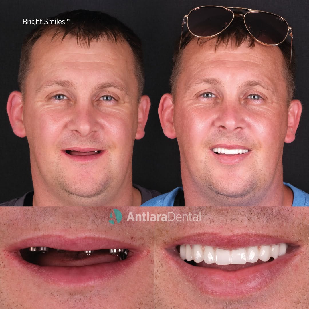 All on 6 dental implants before and after