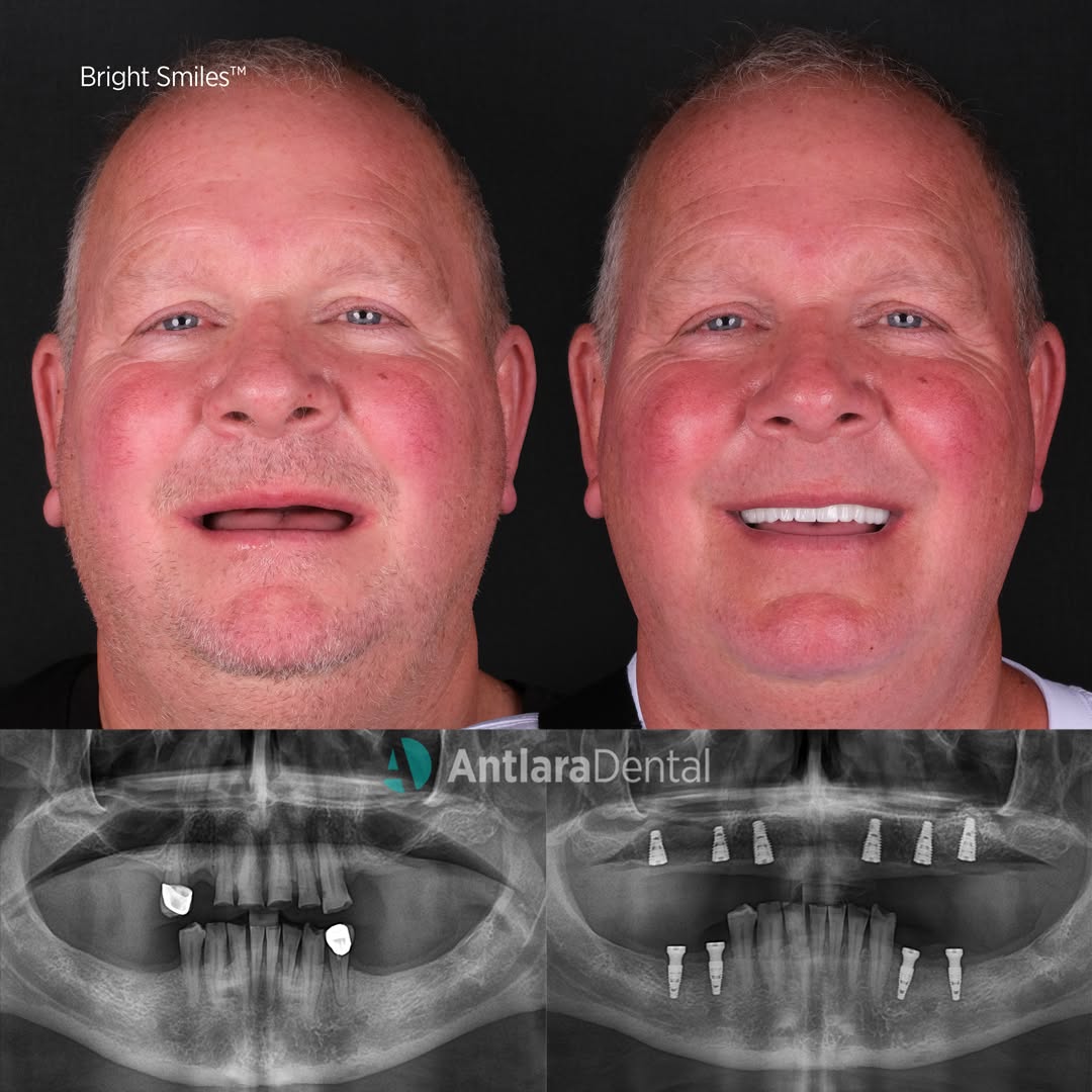 All on 6 dental implants before and after