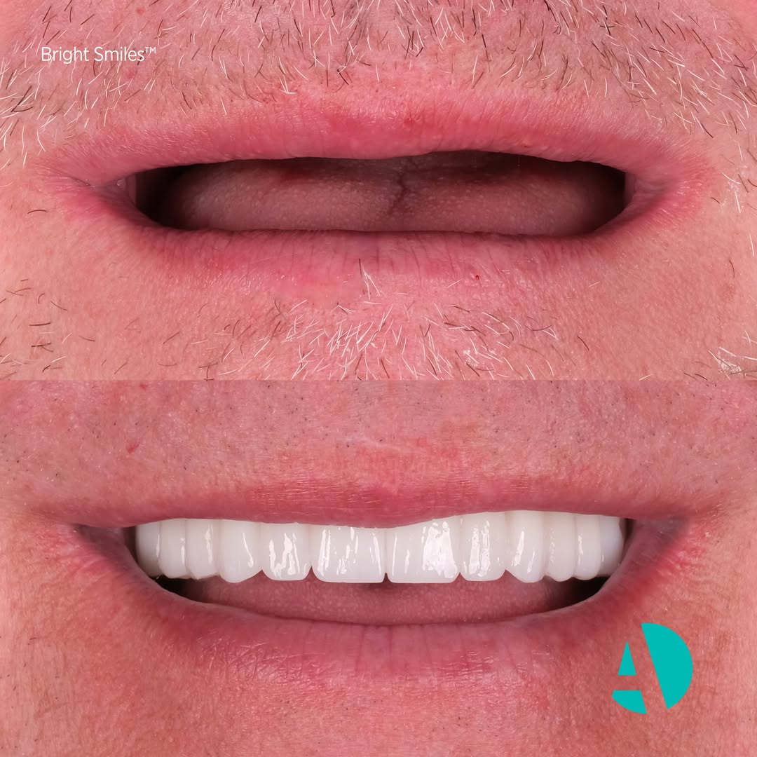 All on 6 dental implants before and after