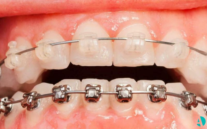 patient teeth upper teeth with metal braces and lower teth with ceramic braces