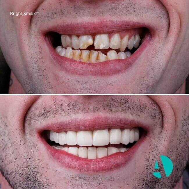 Cosmetic Dentistry before after taken in dental clininc located in Turkey