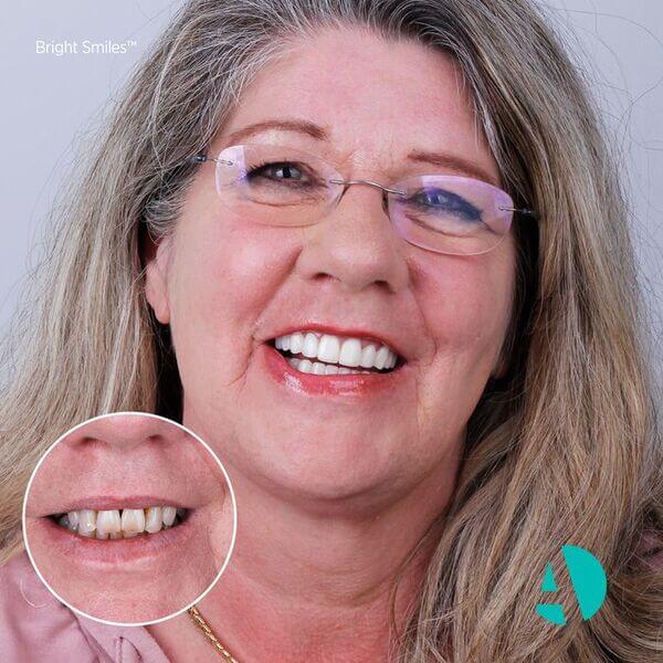 women with glasses smiles after having her dental veneers