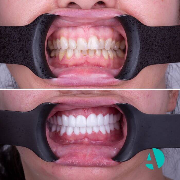 veneers before after taken by dental clinic in Antalya