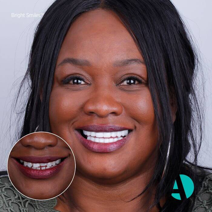Black women smiles after having veneers operation.
