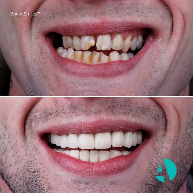 emax crowns before after in turkey