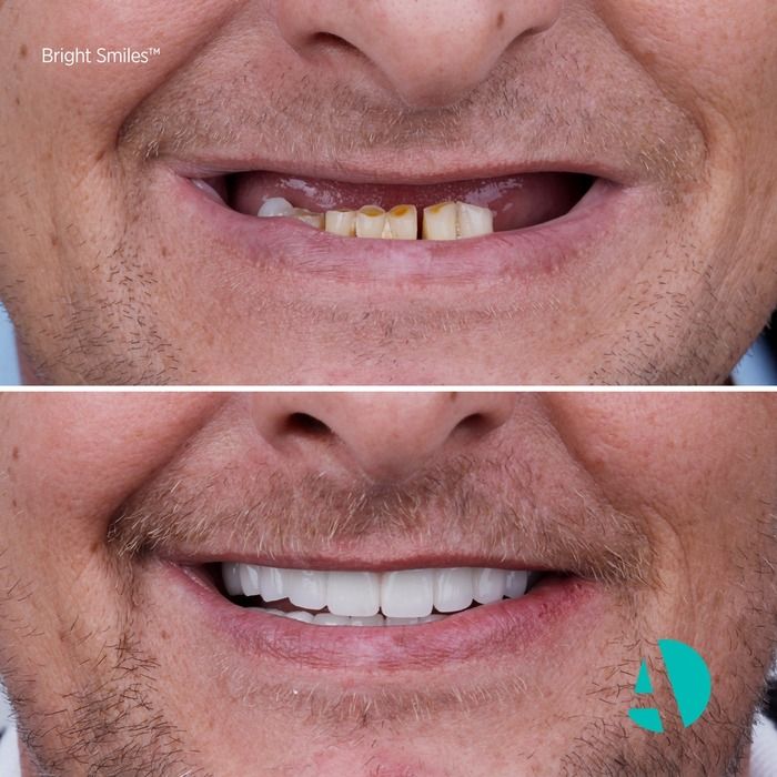 Smile Makeover before after