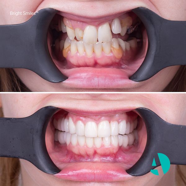 dental braces before after image Antalya Turkey
