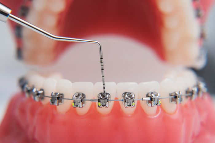 metal braces are aligning on the teeth model 